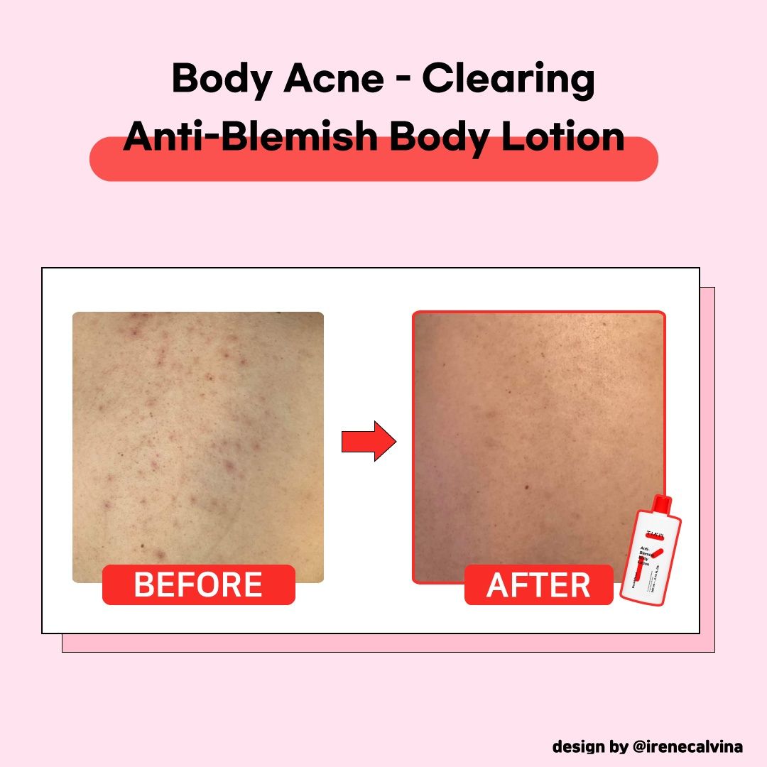 Anti-Blemish Body Lotion-TIAM-HBYTALA